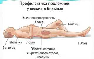 Лечение водянки на спине — эффективные методы и профилактика