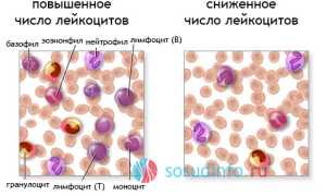 Понижение количества лейкоцитов в крови