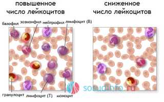 Понижение количества лейкоцитов в крови