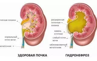 Что такое нефроз почек и как его лечить