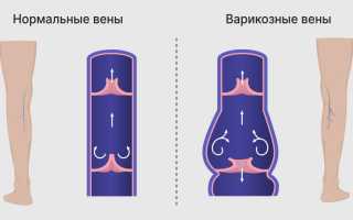 Эластичные стенки сосудов — где они встречаются?