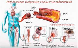 Признаки атеросклероза аорты сердца — что нужно знать