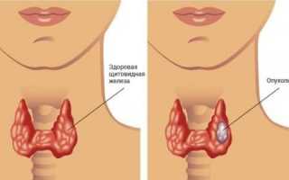 Симптомы и лечение опухоли щитовидной железы