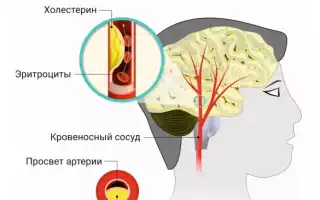 Атеросклероз магистральных артерий головы — что это такое?