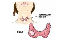 Что такое гипоэхогенный узел щитовидной железы?