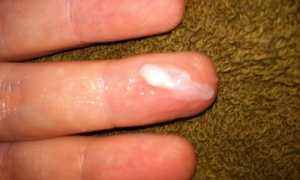 Белый налет на половых губах