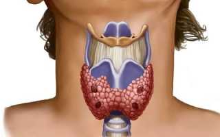 О чем свидетельствует неоднородная структура щитовидной железы?