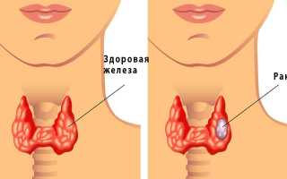 Что такое фокальные изменения в щитовидной железе?