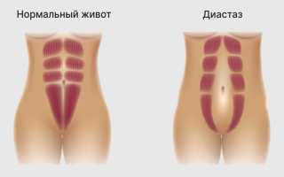 Тяга внизу живота на 4 неделе беременности — форумные советы