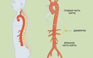 Кальцинированные бляшки в брюшной аорте — причины и последствия