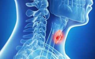 Что такое токсическая аденома щитовидной железы?