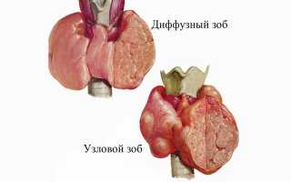 Виды зоба щитовидной железы