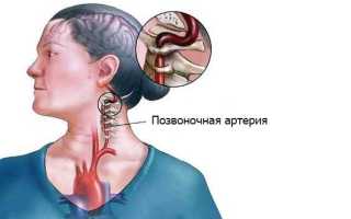 Тромбоз шеи — основные симптомы и признаки
