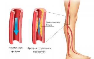 Стенозирующий атеросклероз — что нужно знать