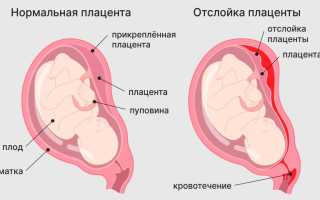 Тянет низ живота на 32 неделе беременности — что делать?