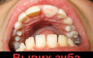 Вывих зуба у ребенка или у взрослого