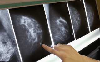 Рак соскового поля у женщин