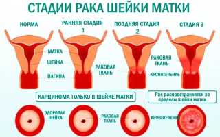 Раковые шейки корня — причины, симптомы и лечение