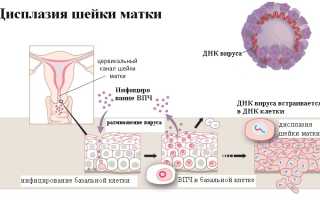 Легкая дисплазия при атрофии плоского эпителия