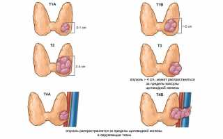 Симптомы и причины рака щитовидной железы у женщин